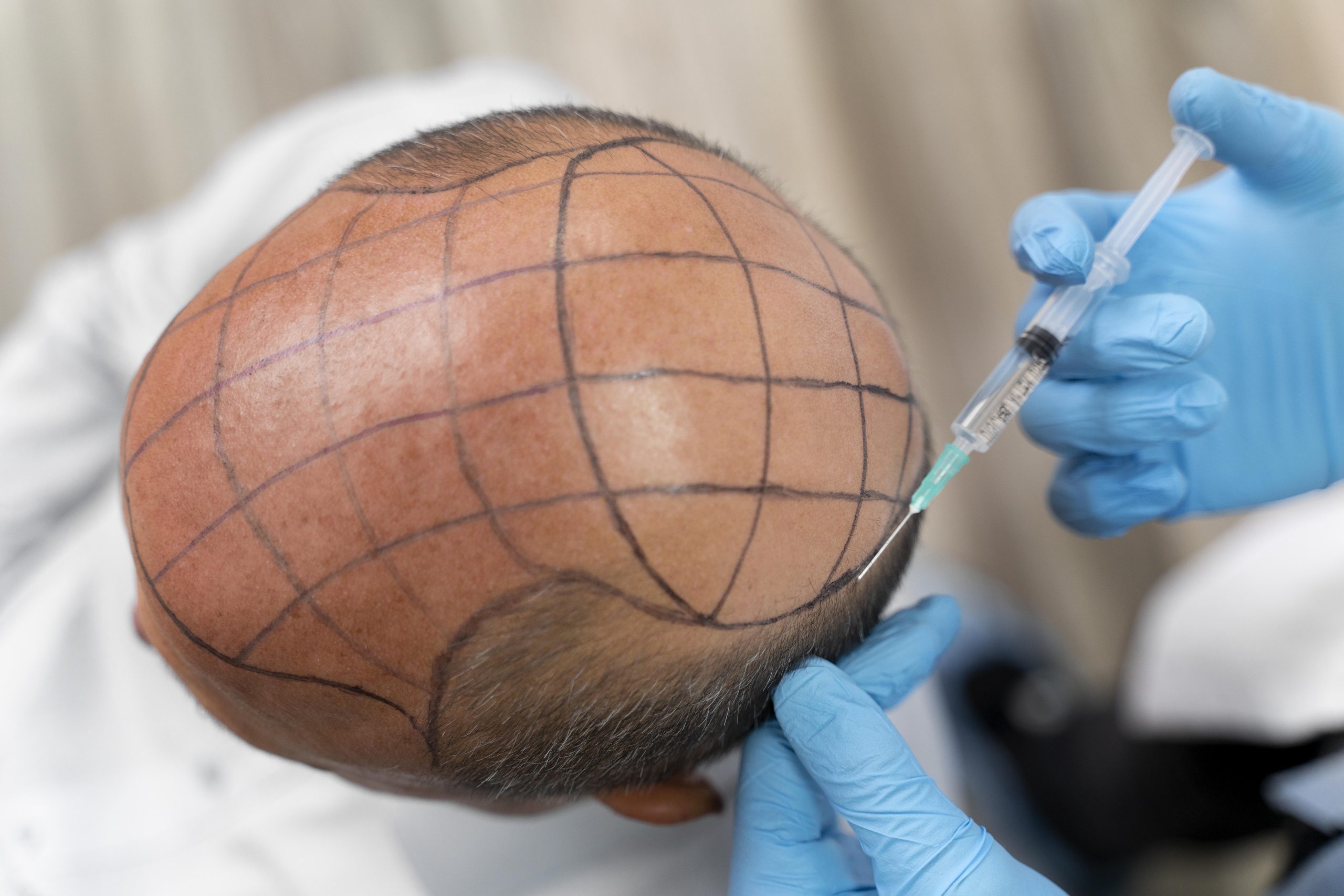 bold-man-going-through-follicular-unit-extraction-process