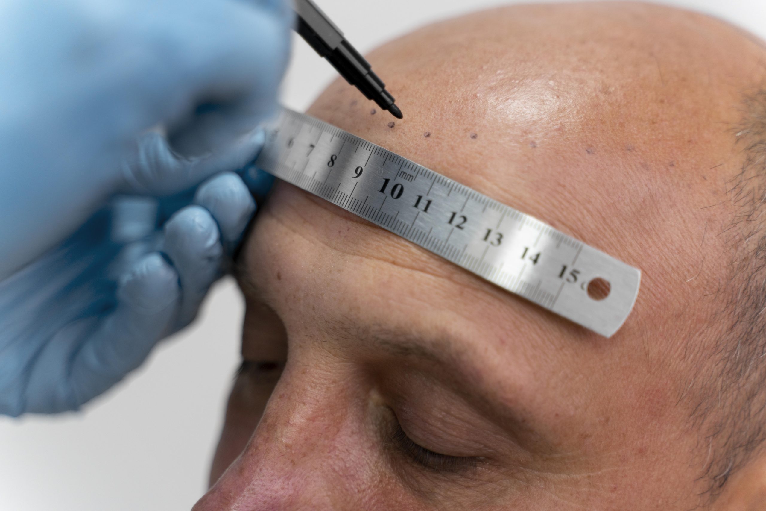 male-going-through-follicular-unit-extraction-process (1)